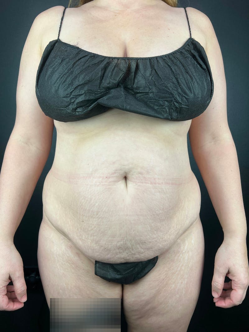 Tummy Tuck Before & After Gallery - Patient 138295 - Image 3
