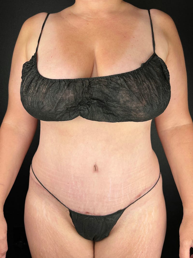 Tummy Tuck Before & After Gallery - Patient 138295 - Image 4