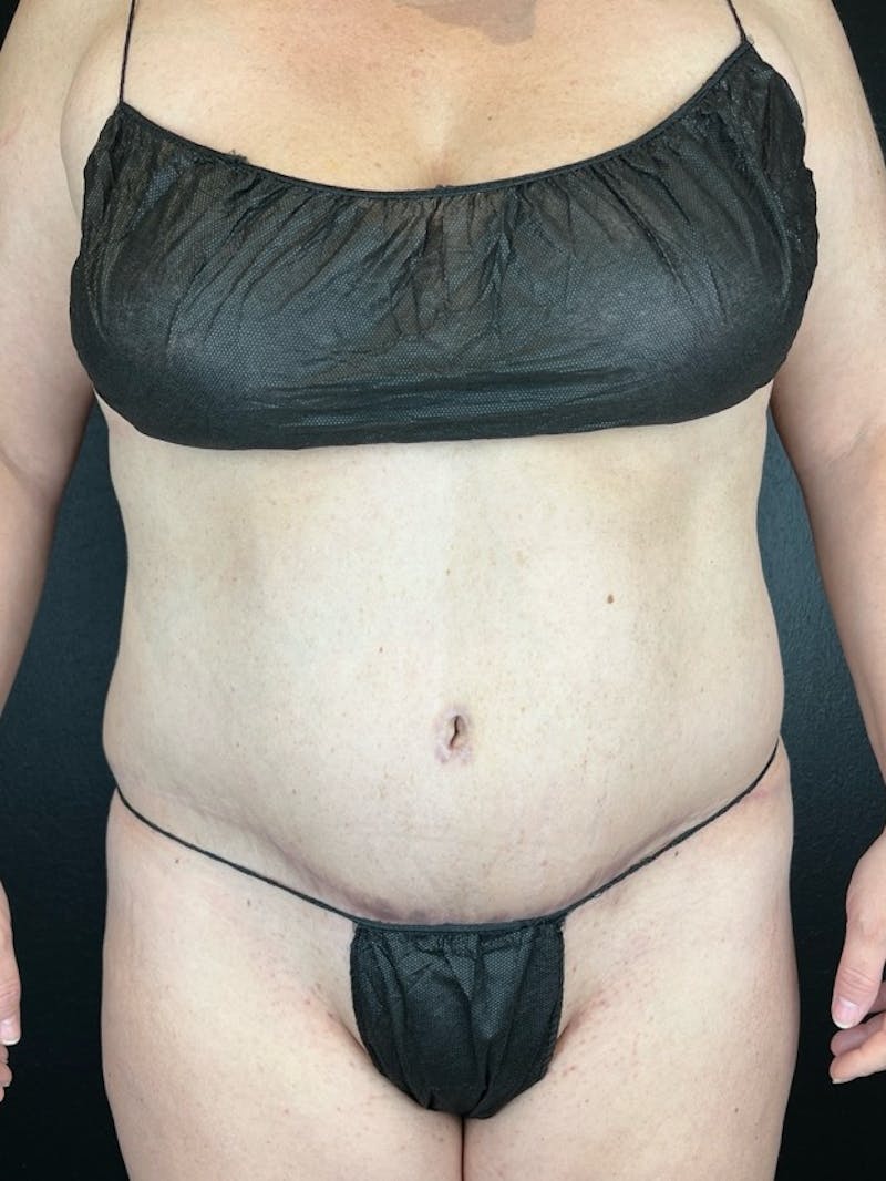 Tummy Tuck Before & After Gallery - Patient 428685 - Image 2