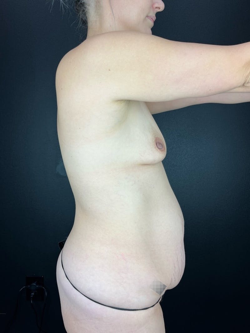 Tummy Tuck Before & After Gallery - Patient 369708 - Image 1