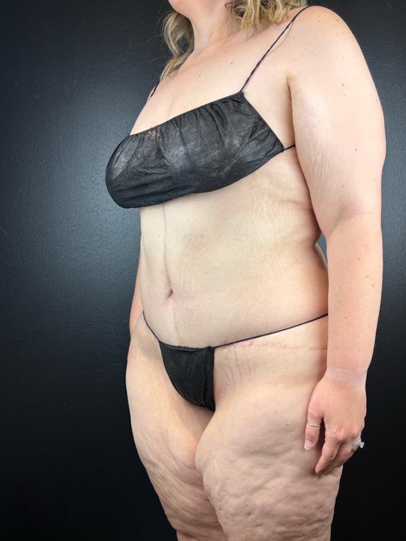 Tummy Tuck Before & After Gallery - Patient 210709 - Image 2