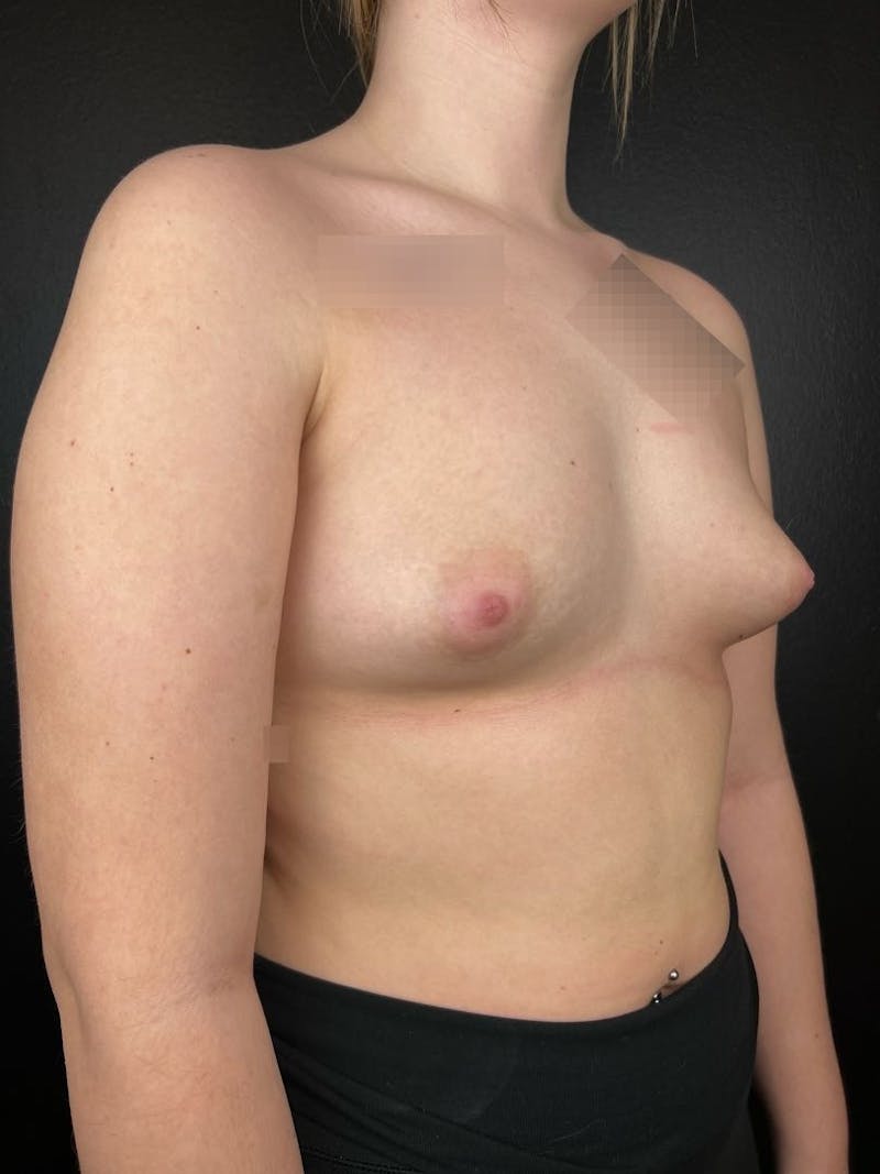 Breast Augmentation Before & After Gallery - Patient 120186 - Image 1