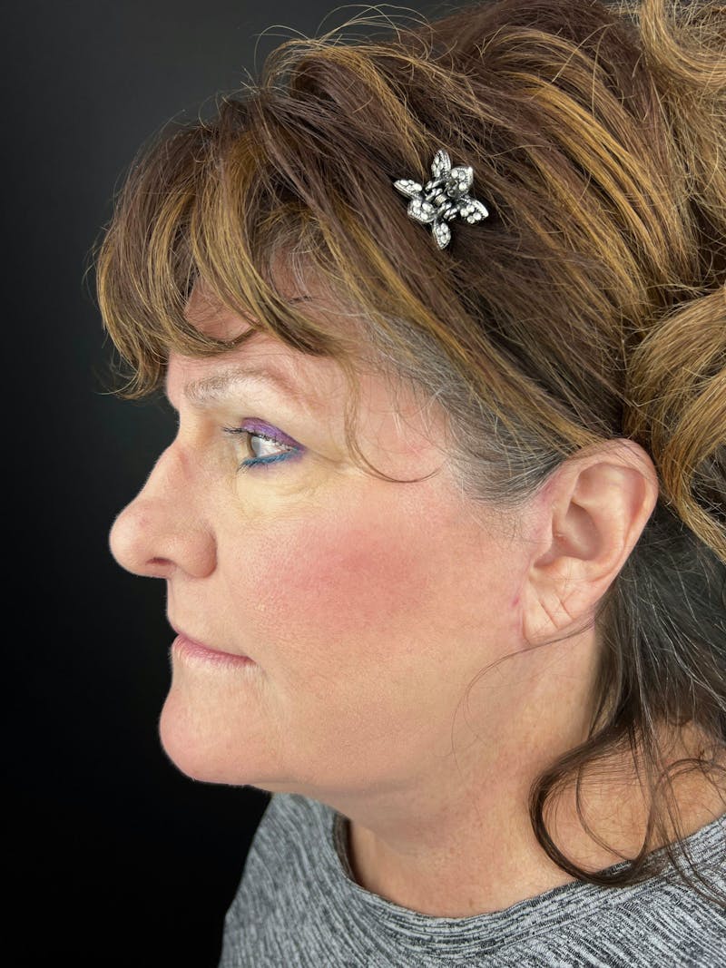 Neck Lift Before & After Gallery - Patient 312327 - Image 2