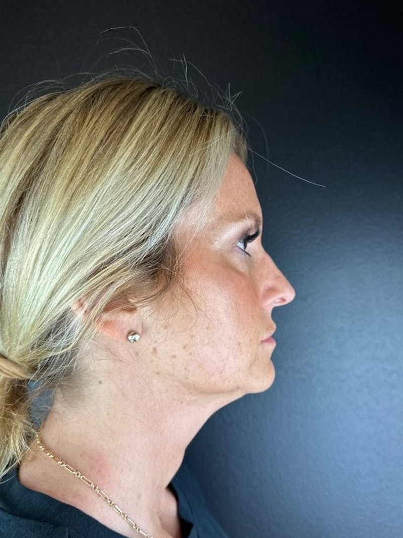 Neck Lift Before & After Gallery - Patient 306905 - Image 1