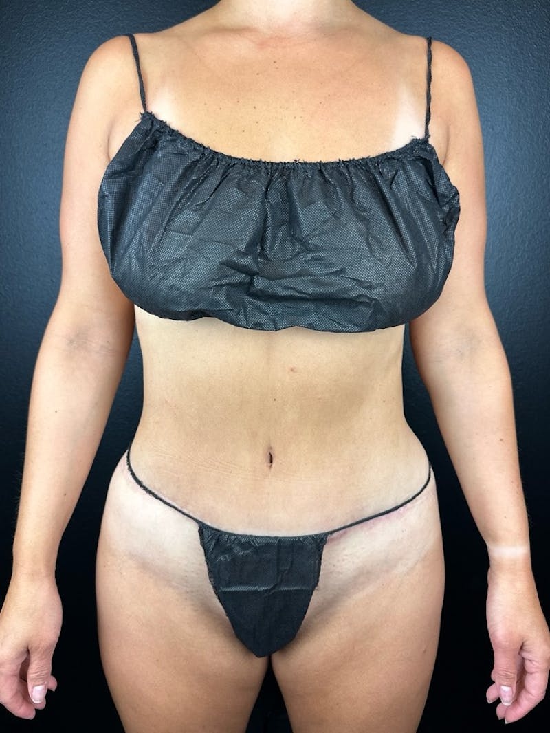 Tummy Tuck Before & After Gallery - Patient 412404 - Image 4