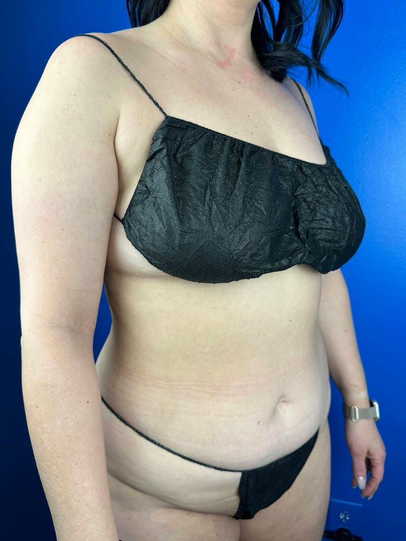 Tummy Tuck Before & After Gallery - Patient 412404 - Image 1