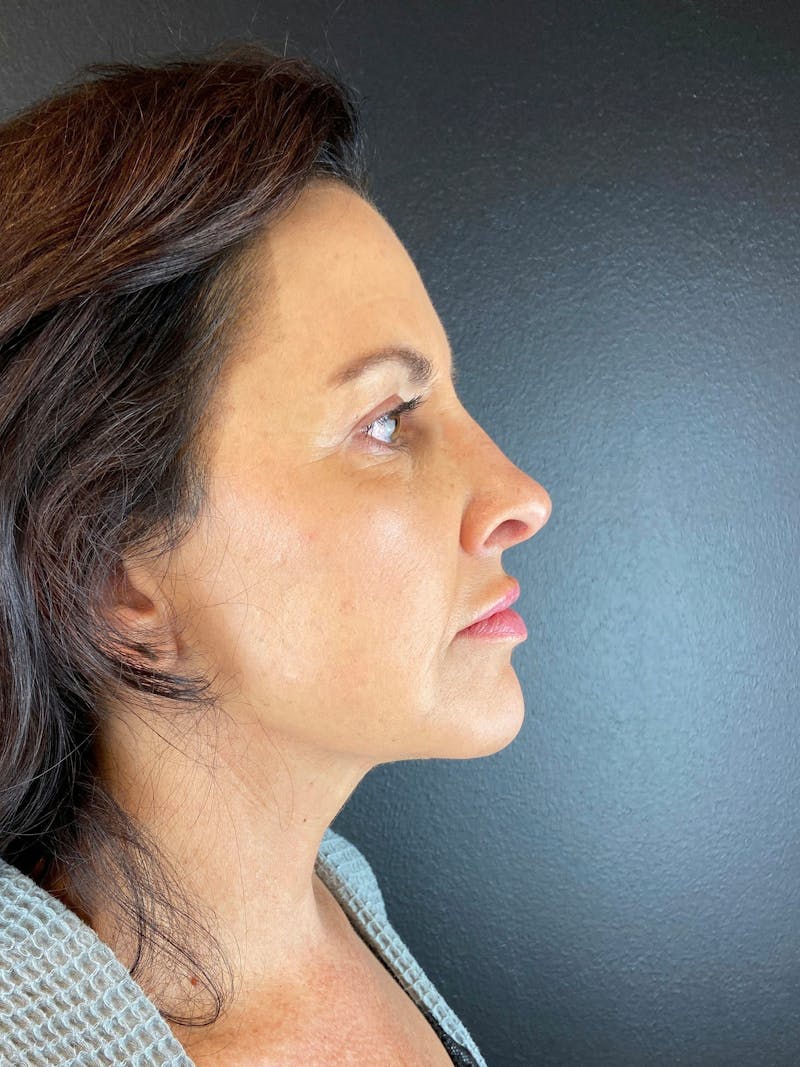 Neck Lift Before & After Gallery - Patient 114256 - Image 2