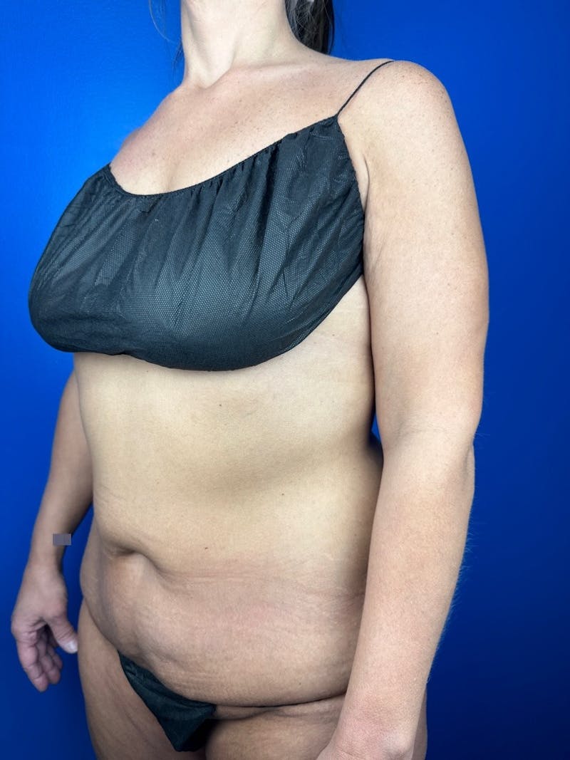 Tummy Tuck Before & After Gallery - Patient 385647 - Image 1