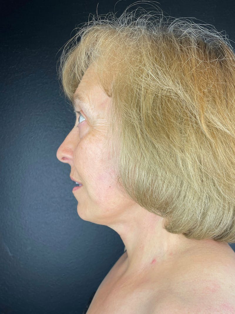 Neck Lift Before & After Gallery - Patient 286052 - Image 2