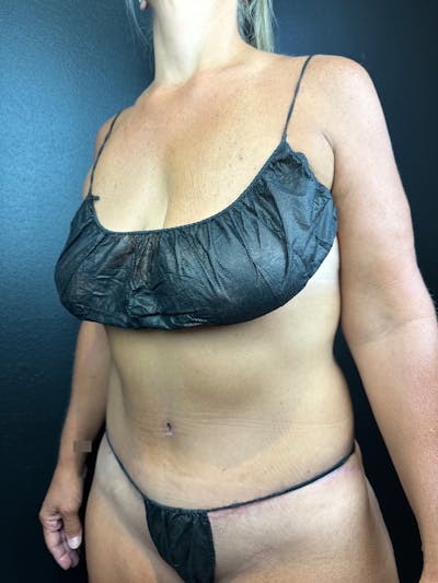 Tummy Tuck Before & After Gallery - Patient 385647 - Image 2