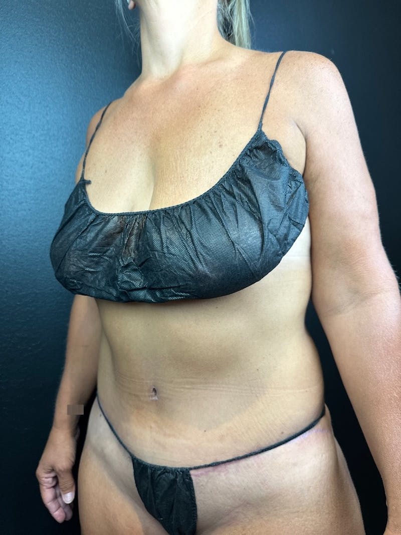 Tummy Tuck Before & After Gallery - Patient 385647 - Image 2