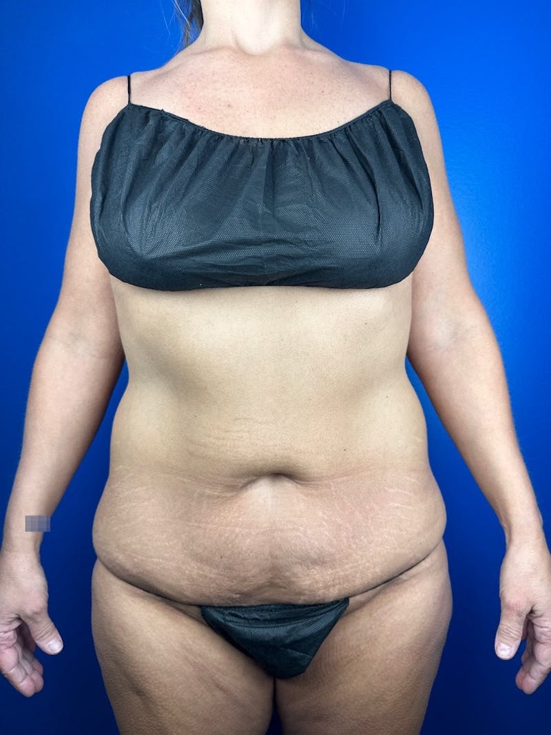 Tummy Tuck Before & After Gallery - Patient 385647 - Image 3