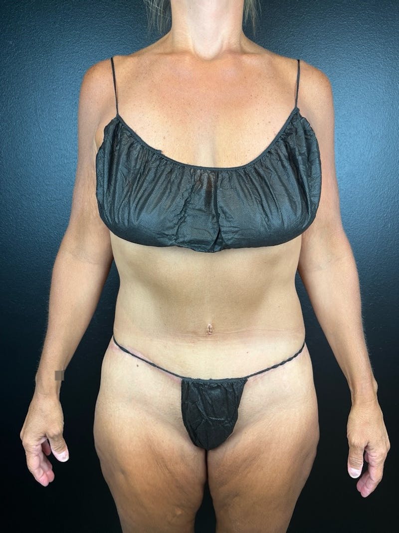 Tummy Tuck Before & After Gallery - Patient 385647 - Image 4