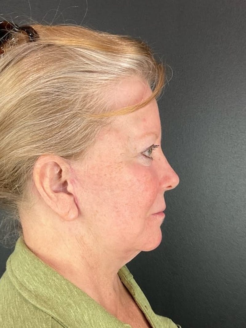 Panfacial Fat Grafting Before & After Gallery - Patient 383893 - Image 4