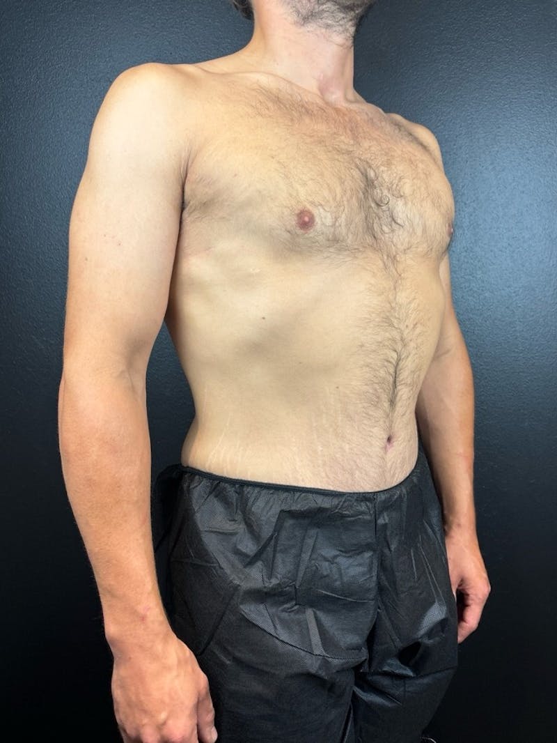 Tummy Tuck Before & After Gallery - Patient 854667 - Image 2