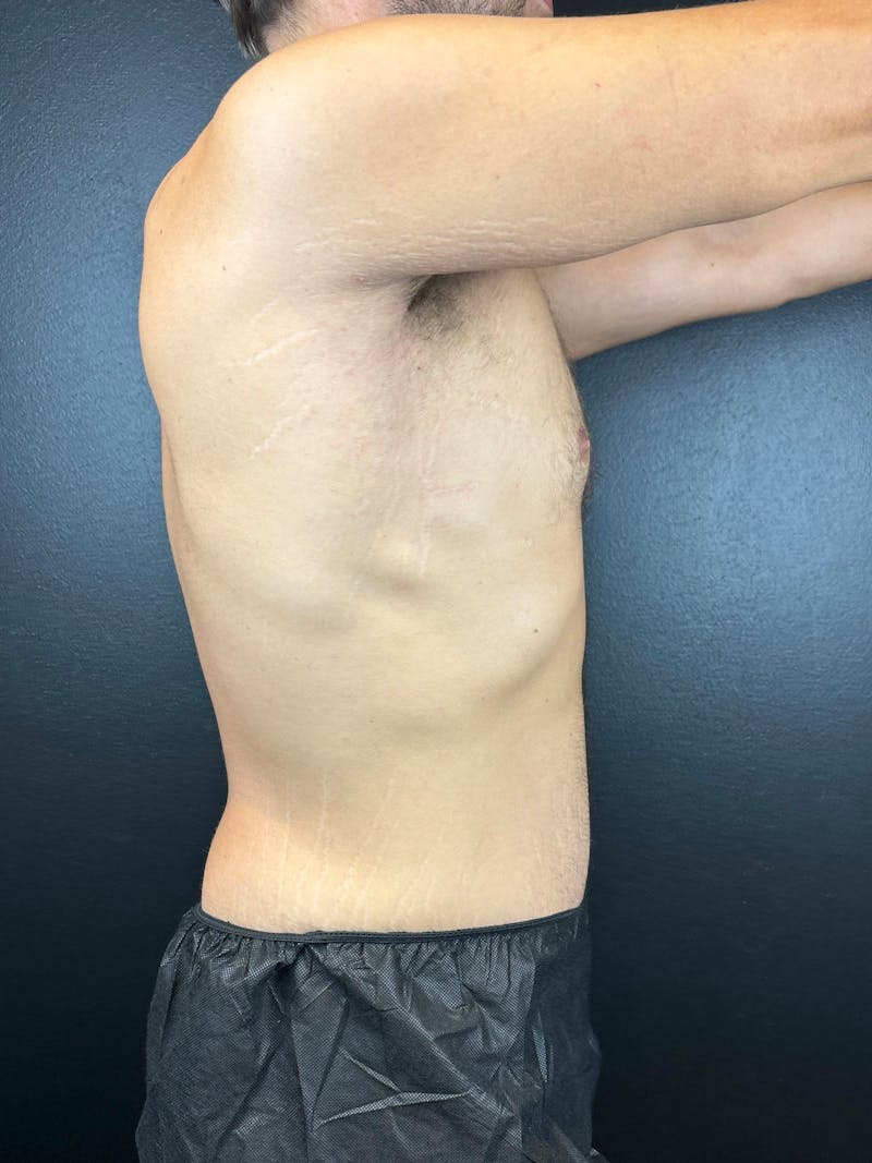 Tummy Tuck Before & After Gallery - Patient 854667 - Image 4