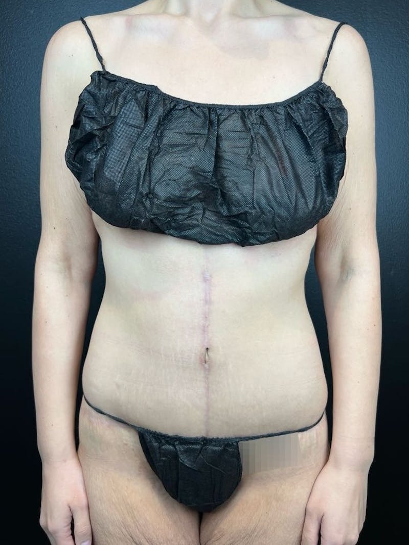 Tummy Tuck Before & After Gallery - Patient 300546 - Image 4