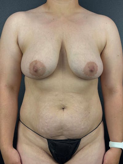 Tummy Tuck Before & After Gallery - Patient 334427 - Image 1