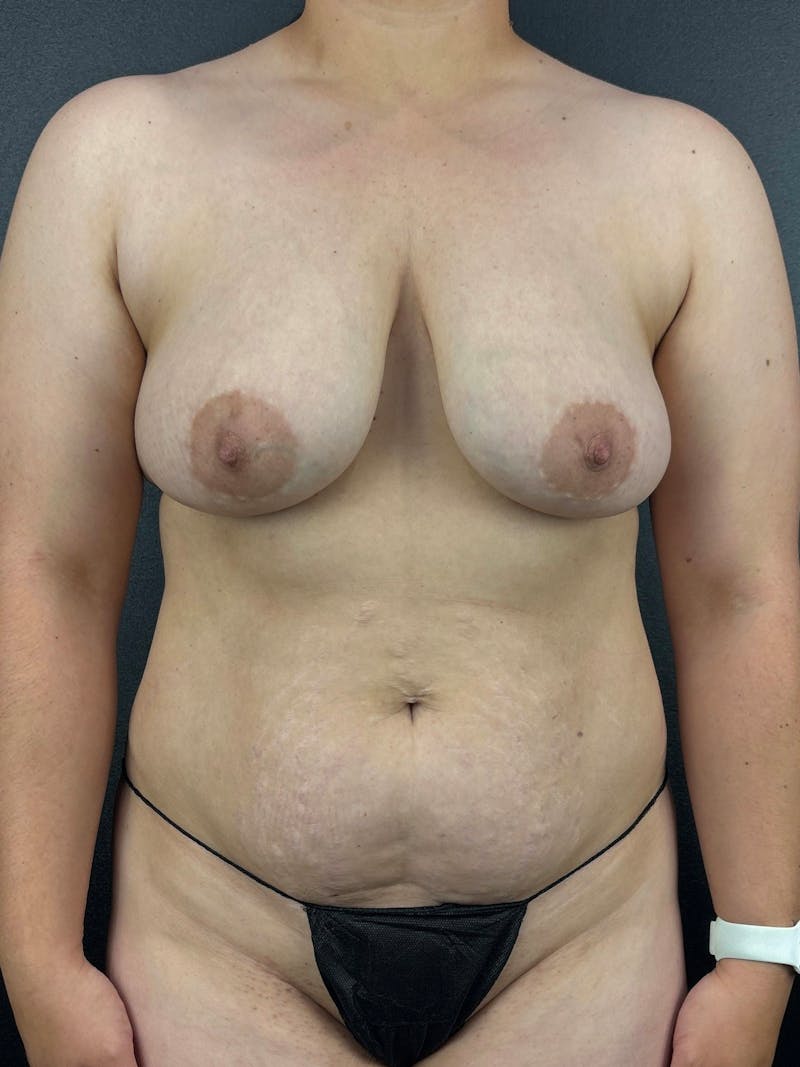 Tummy Tuck Before & After Gallery - Patient 334427 - Image 1