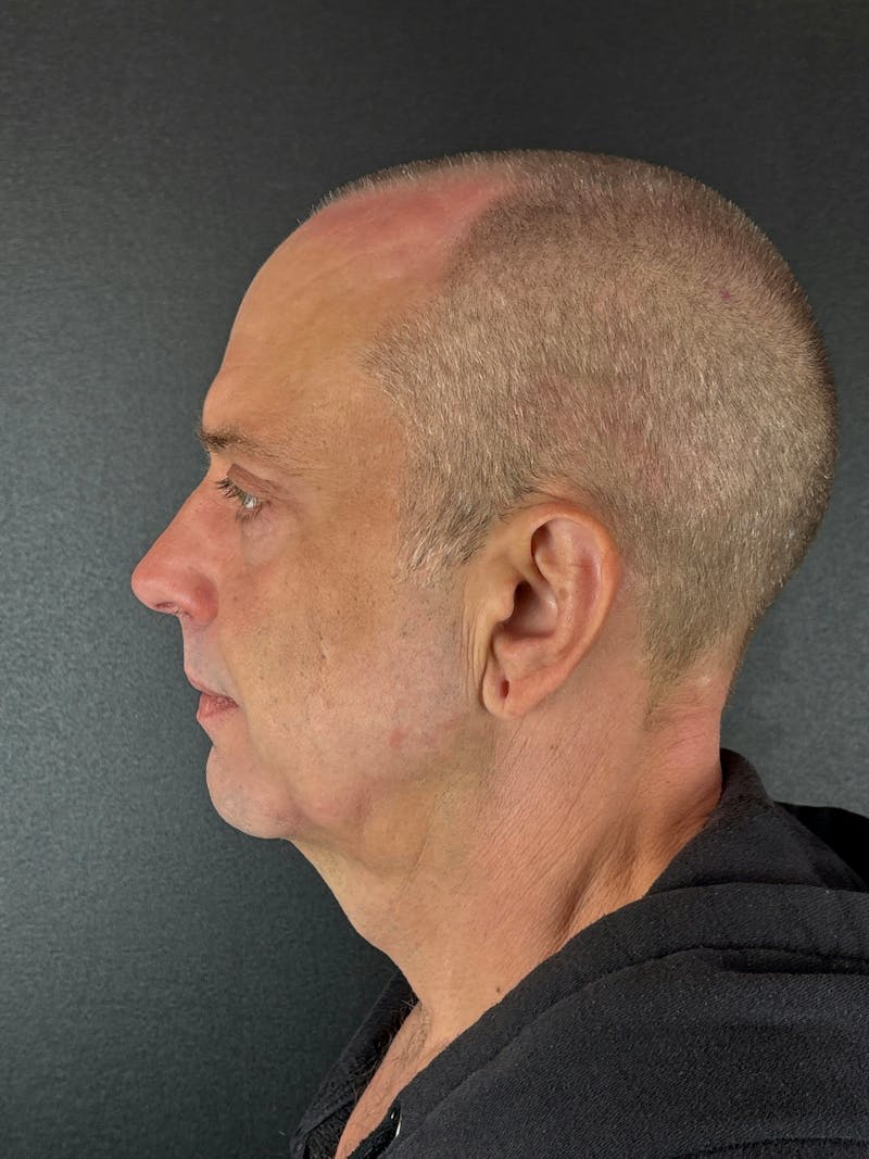 Neck Lift Before & After Gallery - Patient 300097 - Image 1