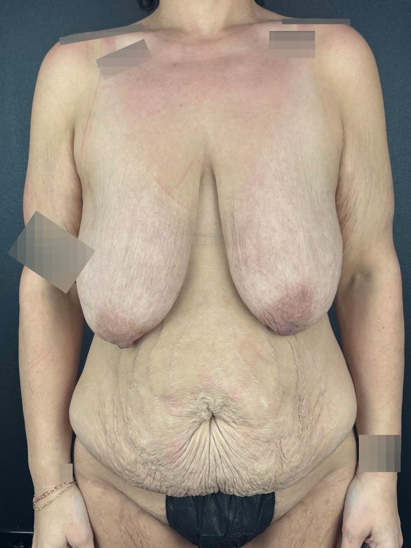 Tummy Tuck Before & After Gallery - Patient 258574 - Image 1