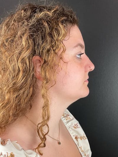 Submental Liposuction Before & After Gallery - Patient 271309 - Image 2