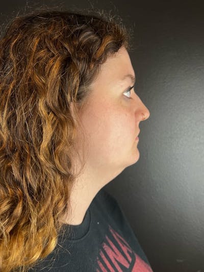 Submental Liposuction Before & After Gallery - Patient 271309 - Image 1