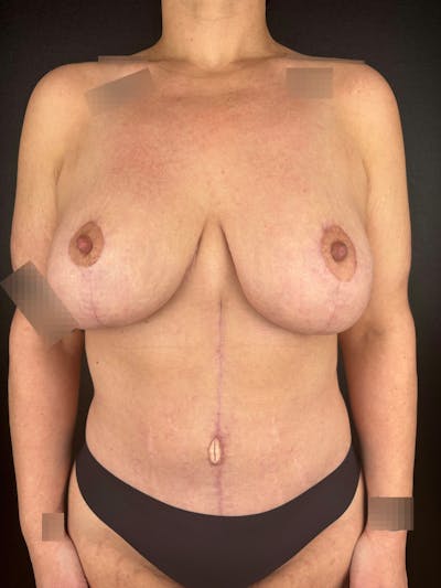 Tummy Tuck Before & After Gallery - Patient 258574 - Image 2