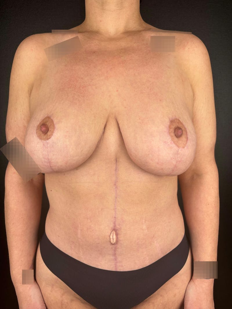 Tummy Tuck Before & After Gallery - Patient 258574 - Image 2