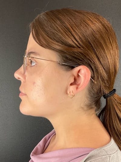 Submental Liposuction Before & After Gallery - Patient 227190 - Image 2