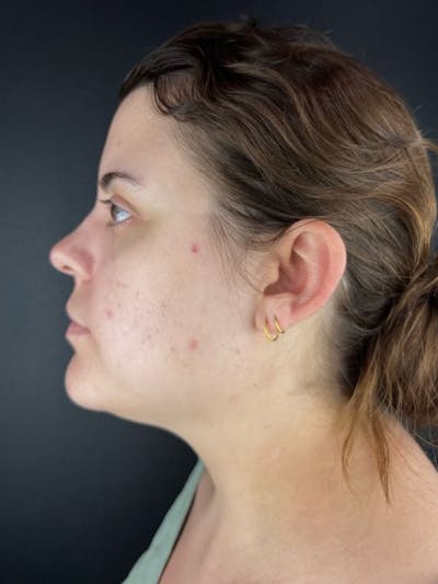 Submental Liposuction Before & After Gallery - Patient 227190 - Image 1