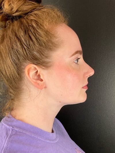 Submental Liposuction Before & After Gallery - Patient 171962 - Image 2