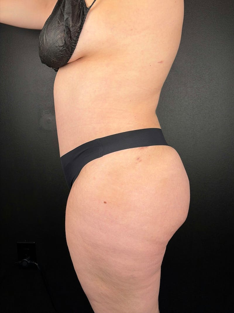 Tummy Tuck Before & After Gallery - Patient 152400 - Image 2