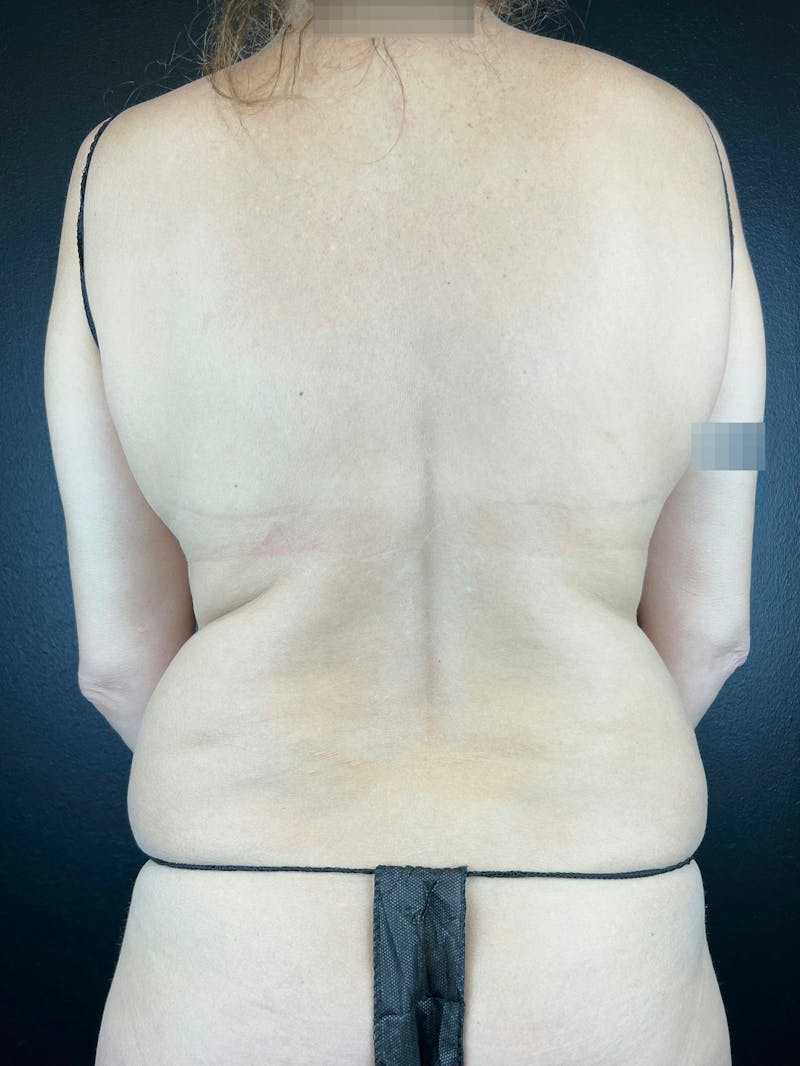 Back (Liposuction) Before & After Gallery - Patient 427680 - Image 1