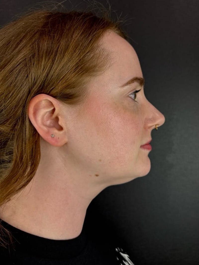 Submental Liposuction Before & After Gallery - Patient 171962 - Image 1