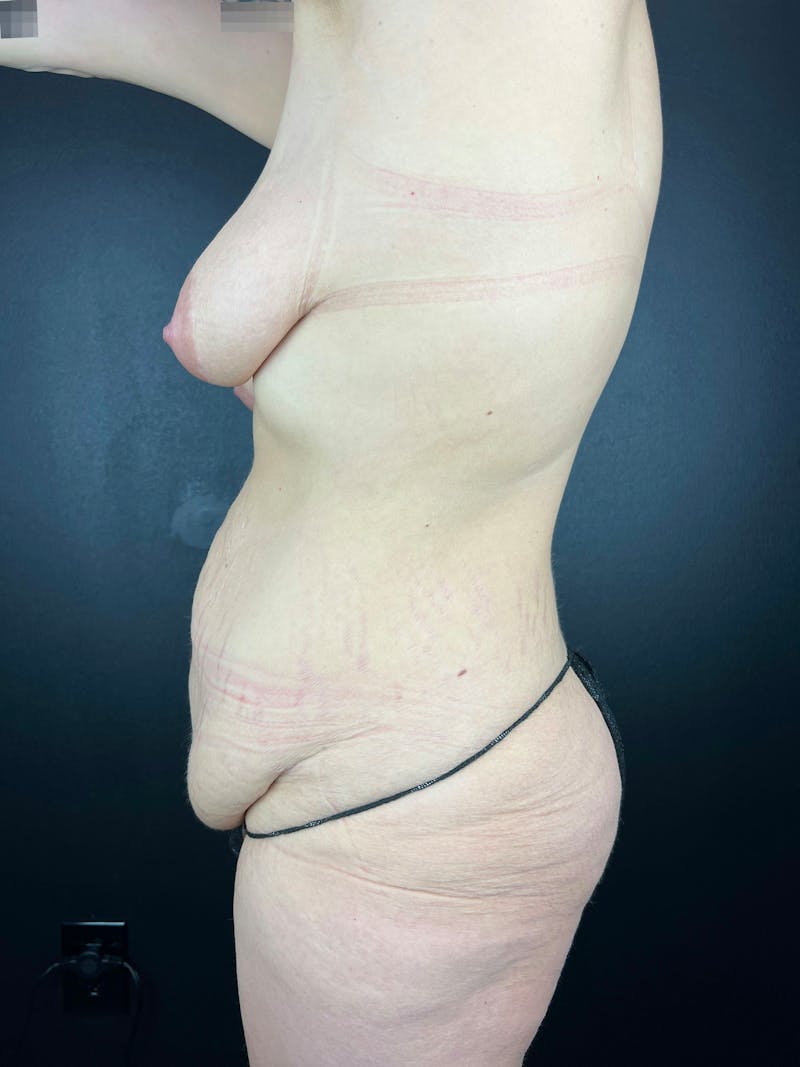 Tummy Tuck Before & After Gallery - Patient 271428 - Image 1