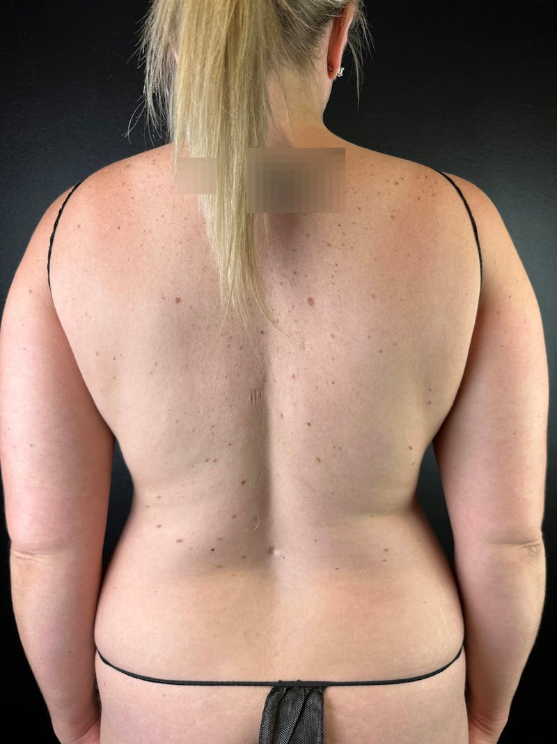 Back (Liposuction) Before & After Gallery - Patient 677416 - Image 1