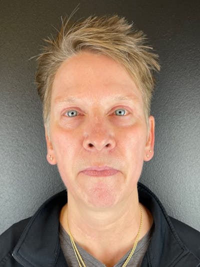 Panfacial Fat Grafting Before & After Gallery - Patient 483239 - Image 2