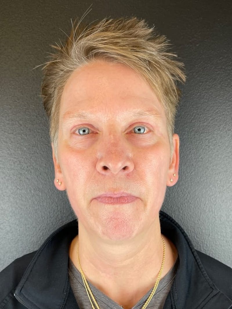 Panfacial Fat Grafting Before & After Gallery - Patient 483239 - Image 2