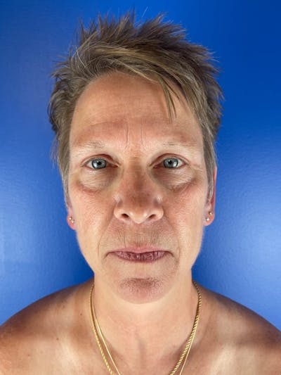 Panfacial Fat Grafting Before & After Gallery - Patient 483239 - Image 1