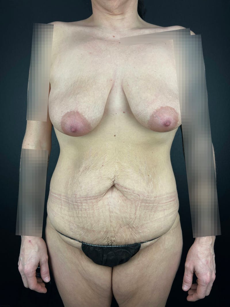 Tummy Tuck Before & After Gallery - Patient 271428 - Image 3