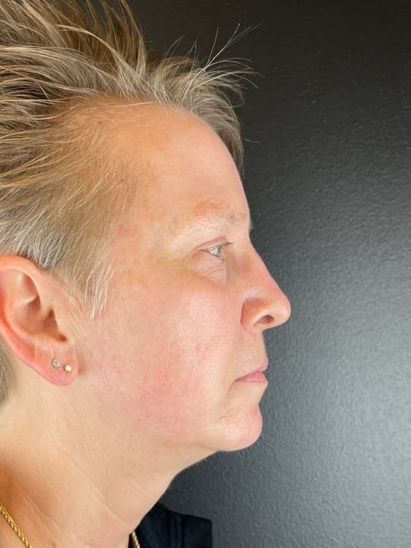 Panfacial Fat Grafting Before & After Gallery - Patient 483239 - Image 4