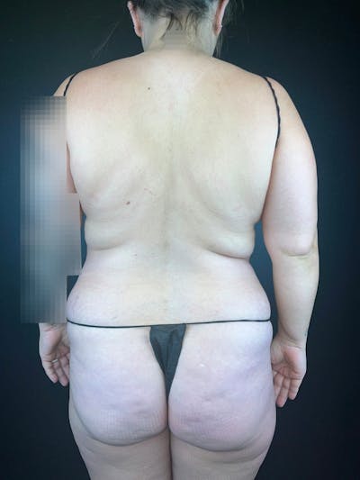 Back (Liposuction) Before & After Gallery - Patient 211534 - Image 1