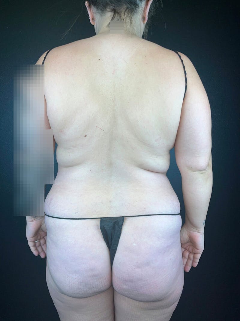Back (Liposuction) Before & After Gallery - Patient 211534 - Image 1
