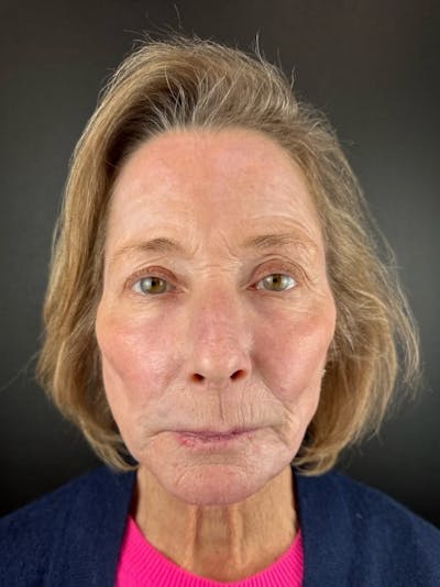 Panfacial Fat Grafting Before & After Gallery - Patient 212176 - Image 2