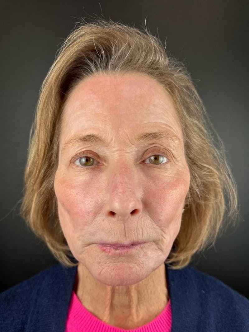 Panfacial Fat Grafting Before & After Gallery - Patient 212176 - Image 2