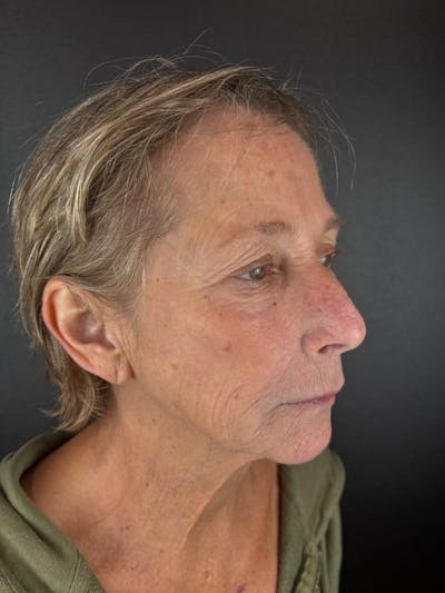 Skin Tightening Before & After Gallery - Patient 684114 - Image 1