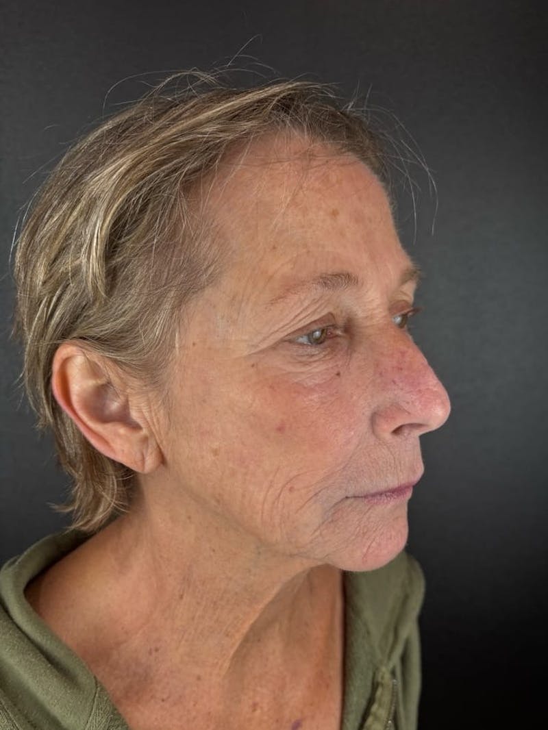 Panfacial Fat Grafting Before & After Gallery - Patient 212176 - Image 3