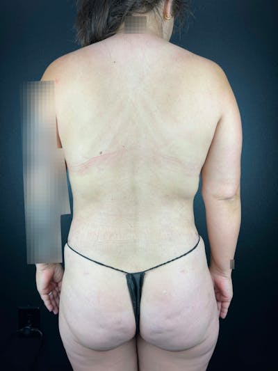 Back (Liposuction) Before & After Gallery - Patient 211534 - Image 2