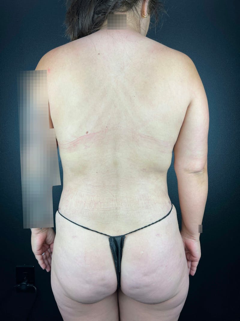 Back (Liposuction) Before & After Gallery - Patient 211534 - Image 2